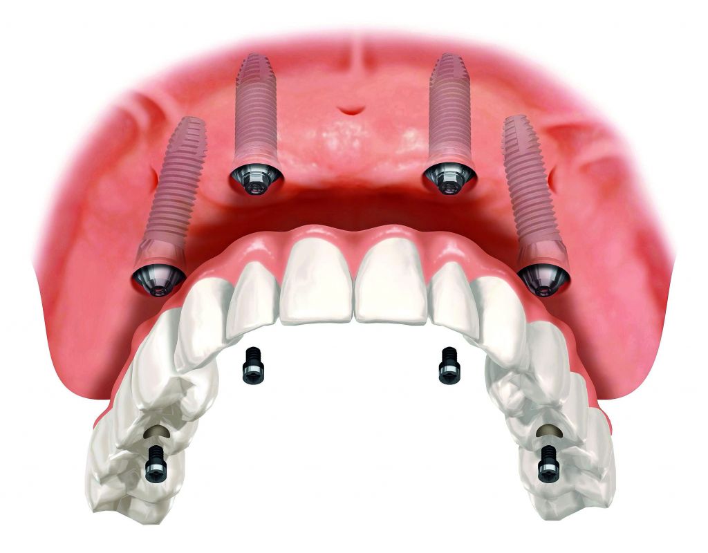 Zobni vsadki Zygoma spreminjajo implantologijo