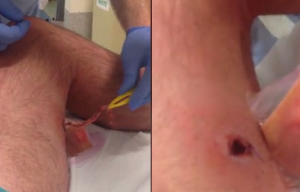 VIDEO: Pajek ga je ugriznil, v nogi nastala luknja