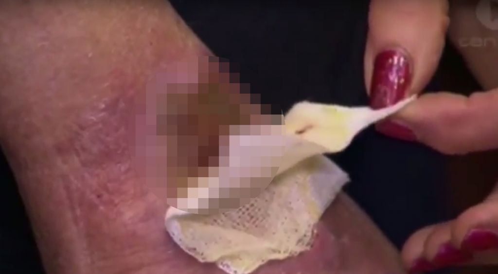 VIDEO: Pičil jo je komar, potem pa se je začela grozljivka