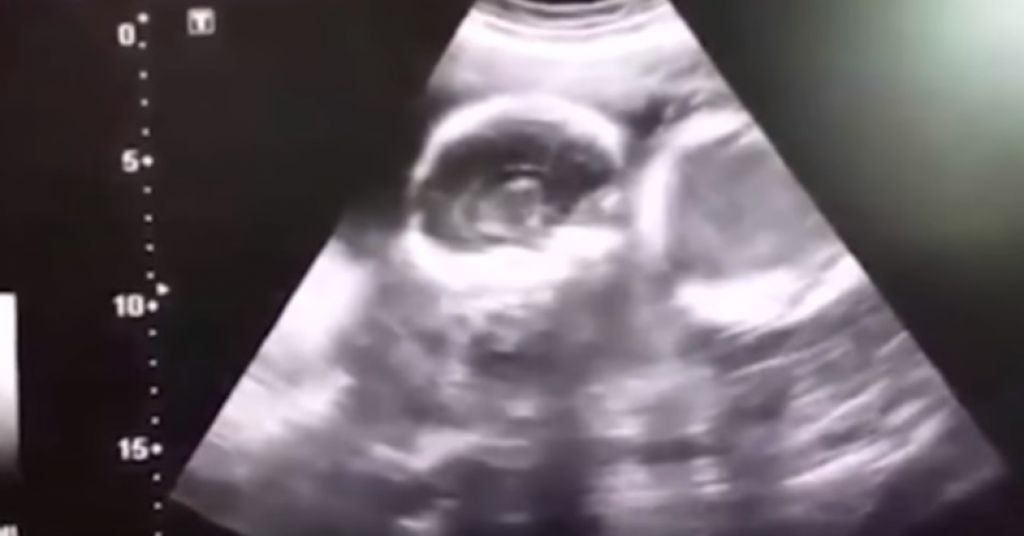 VIDEO: Z aparati so jo ohranjali pri življenju, ko sta se dvojčka rodila, je umrla