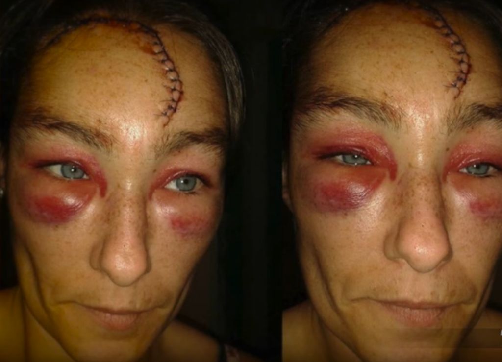 Grozljiv napad na žensko: rano na glavi so ji zašili z več kot 60 šivi
