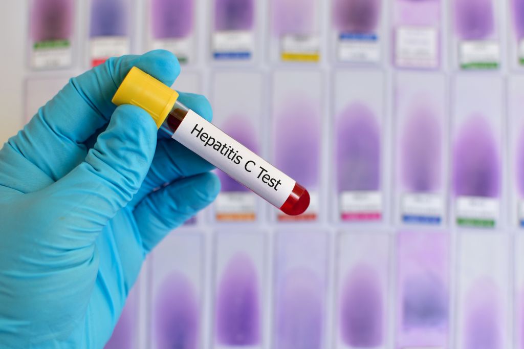 Hepatitis C ima 8000 Slovencev